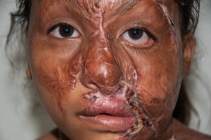 Burns Patients from Indonesia - 2