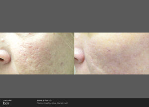 Icon Laser before and after 03, Rodin Clinic Perth