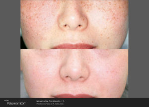 Facial pigmentation treatment before and after 02, ICON Laser, Rodin Clinic Perth