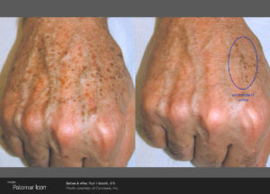 Icon laser treatment before and after 01, hand pigmentation