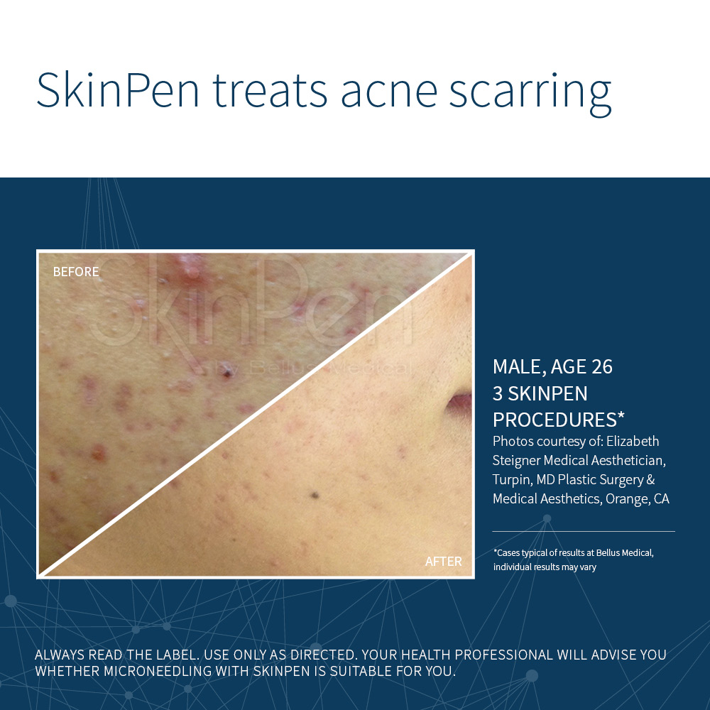 Skin Pen for acne, before and after 03, Rodin Clinic Perth