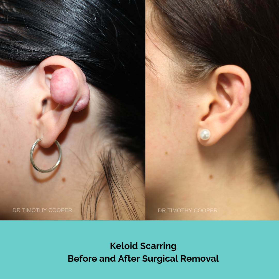 Keloid Scarring - Rodin Clinic Keloid Scarring - Rodin Clinic