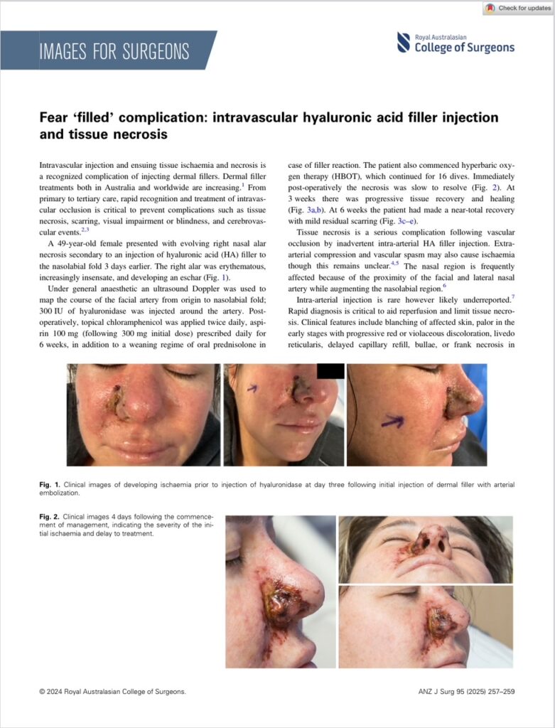 Fear ‘filled’ complication: intravascular hyaluronic acid filler injection and tissue necrosis - 1