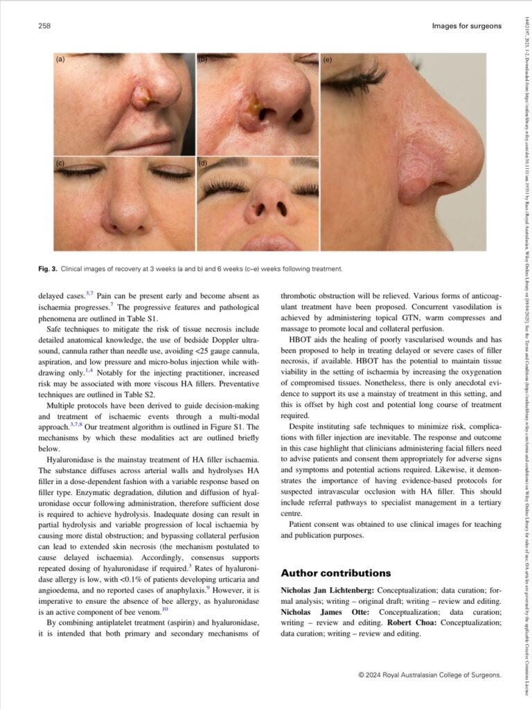 Fear ‘filled’ complication: intravascular hyaluronic acid filler injection and tissue necrosis - 2
