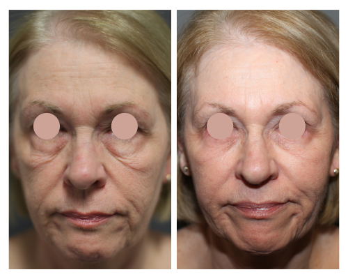 Blepharoplasty before and after 01, Rodin Clinic Perth