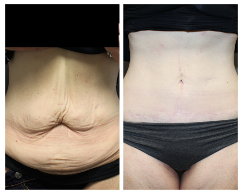 Abdominoplasty before and after 01, Rodin Clinic Perth