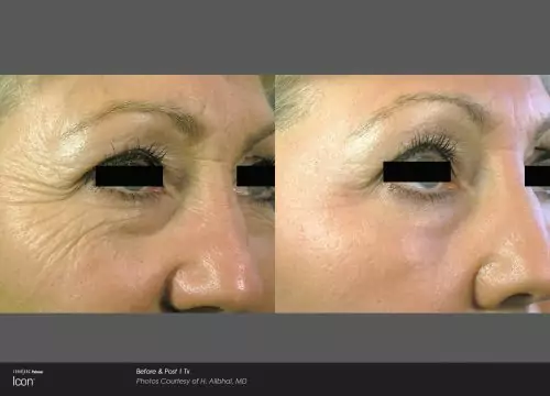 Anti Wrinkle Injections B&A 01 Wrinkle relaxers before and after 01, Rodin Clinic Perth